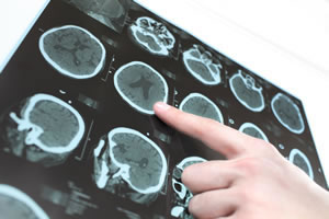 Neurocirurgia Pediátrica em Campinas