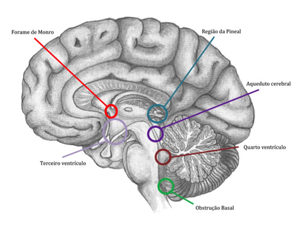 Neurocirurgião especialista em Hidrocefalia